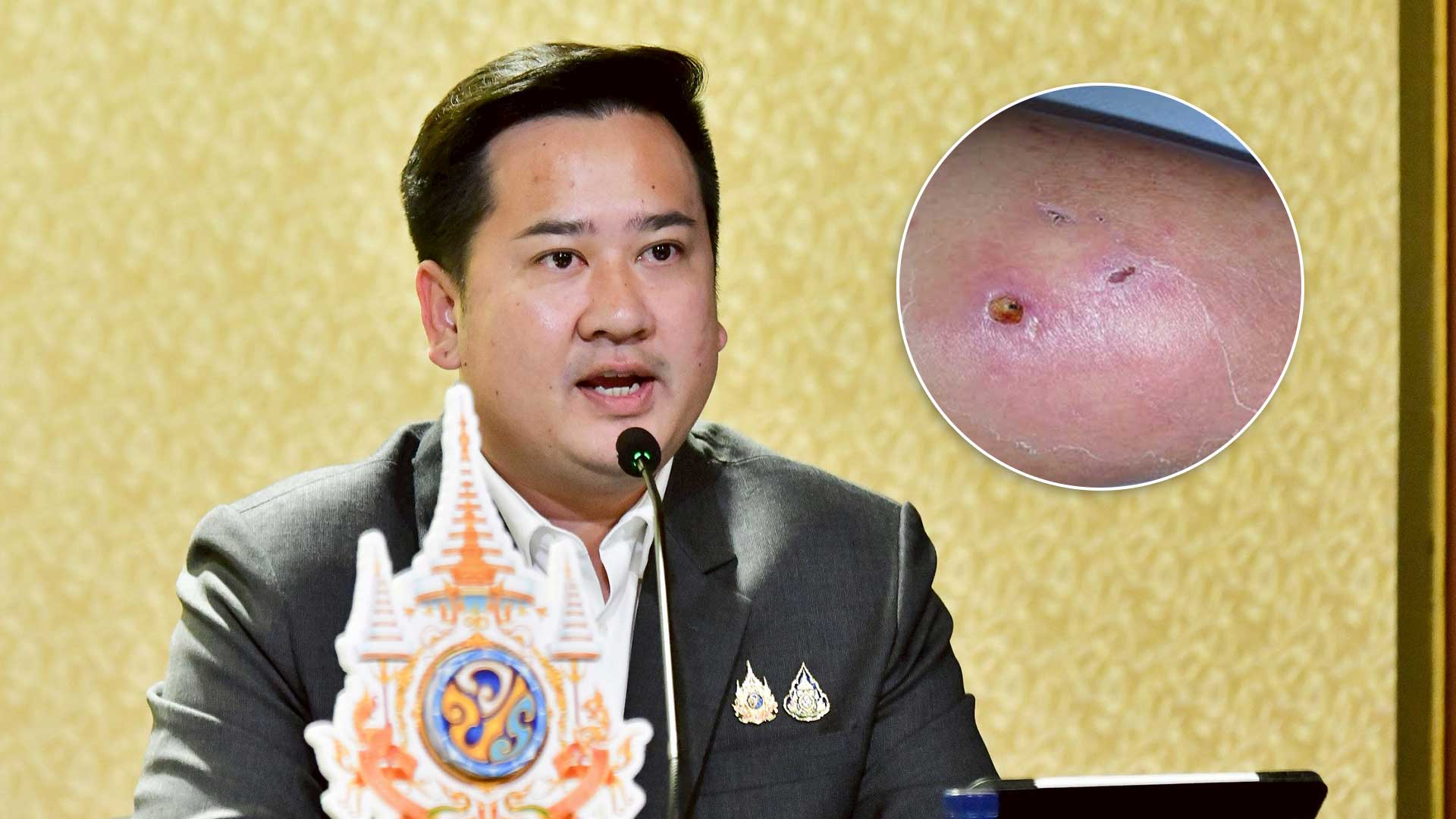 รัฐบาล เตือน ‘ไข้ดิน’ ระบาดอีสานหนัก ยอดป่วยพุ่ง ดับแล้ว 92 ราย เกษตรกรเสี่ยงสูง 1 ไข้ดิน3